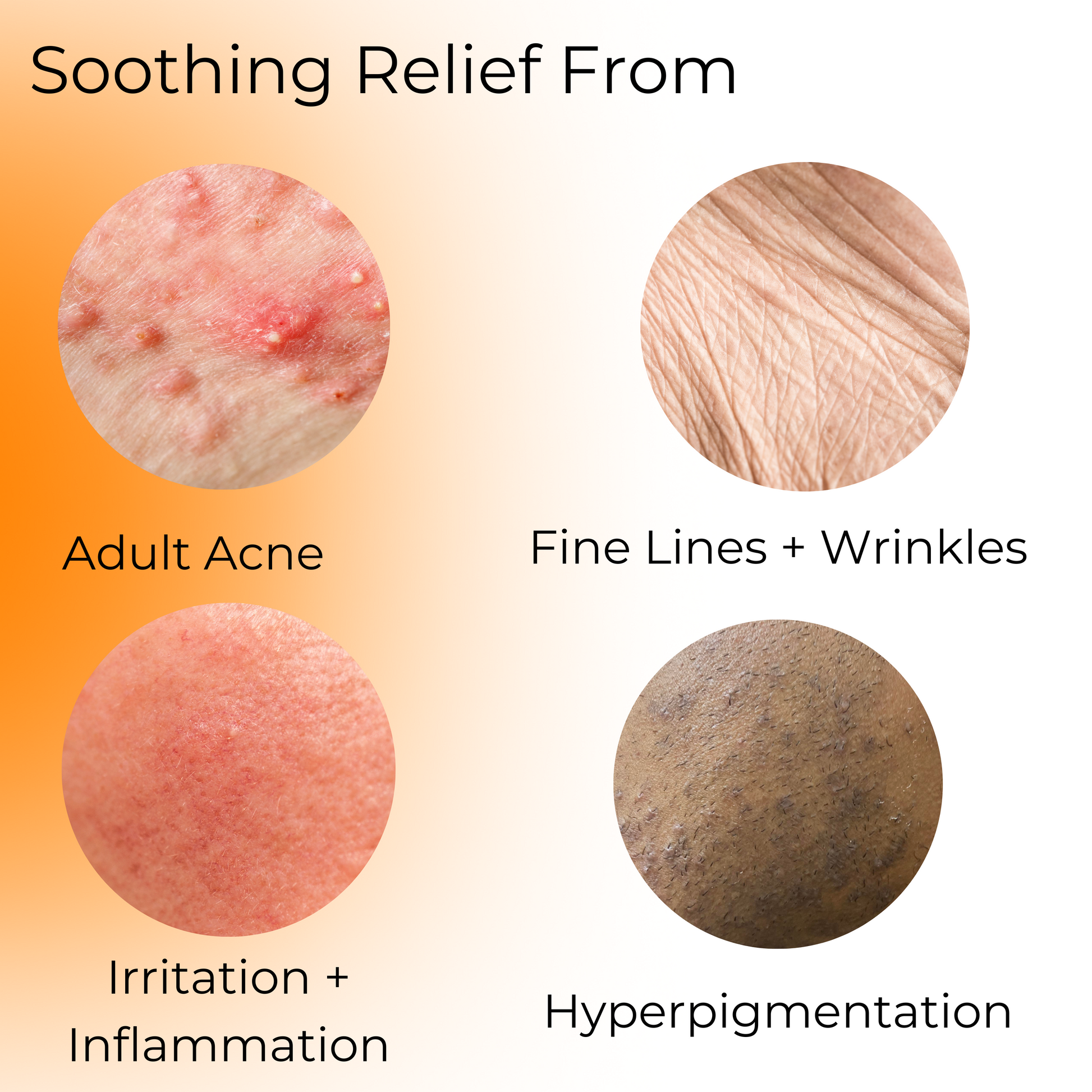 Soothing relief from: Adult Acne, fine lines and wrinkles, irritation and inflammation, and hyperpigmentation.