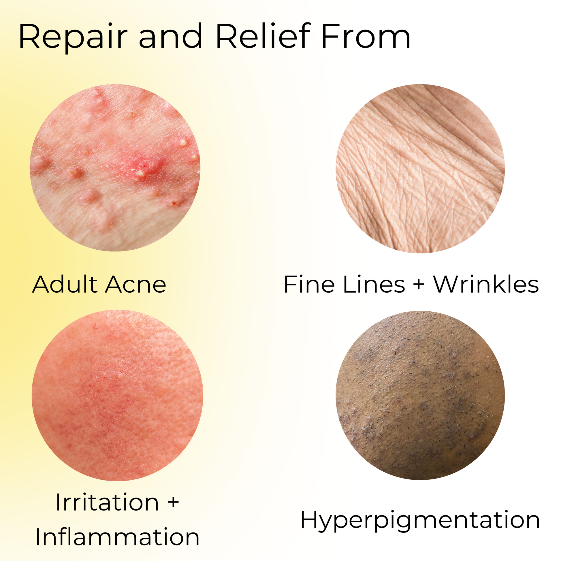 Repair and Relief from: Adult Acne, Fine Lines and wrinkles, Irritation and Inflammation, hyperpigmentation.
