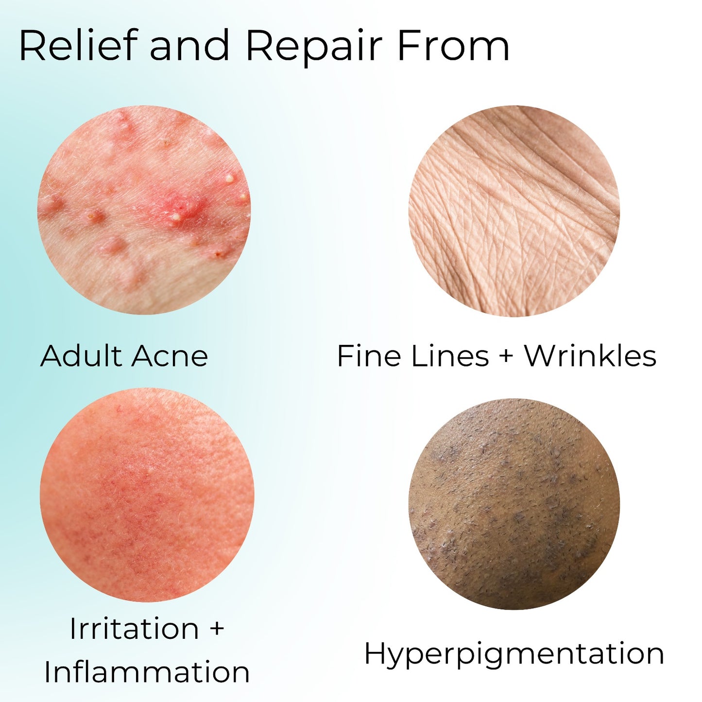 Super Nourishing Cleanser provides relief and repair from: adult acne, fine lines and wrinkles, irritation and inflammation, and hyperpigmentation.