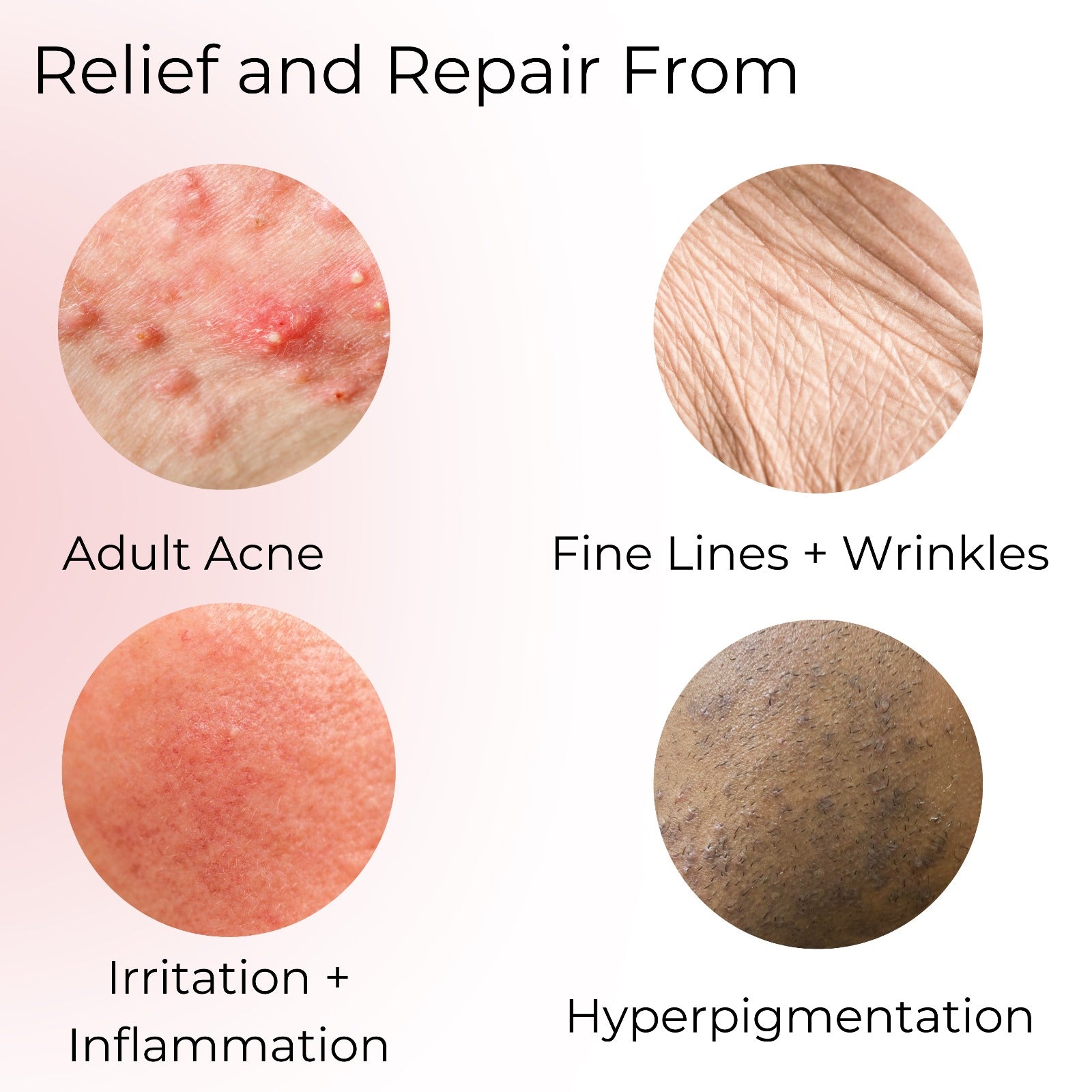 Super Nourishing Toner provides relief and repair from adult acne, fine lines and wrinkles, inflammation, and hyperpigmentation.