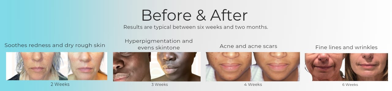 Photo results of how Gleem Beauty Skincare products have improved the skin of people of races and age groups.