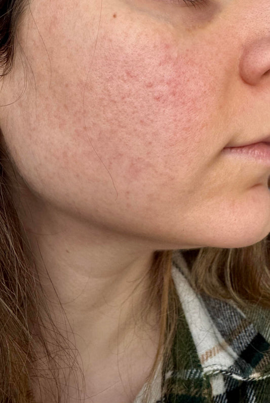 Post-Chemo; Barrier Damaged Skin Is Not “Sensitive” — It’s Protective!