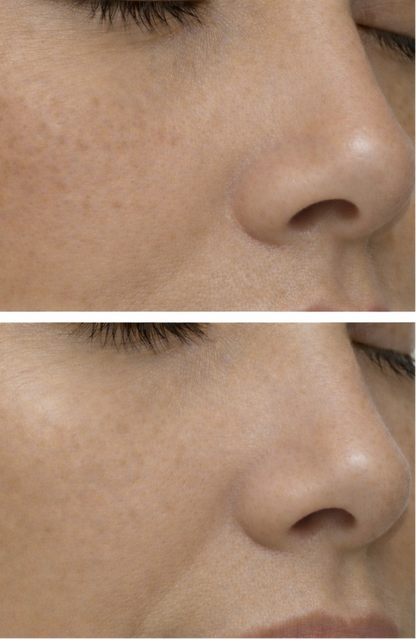Before and after comparison of a person's face with text indicating 'After 4 weeks'.