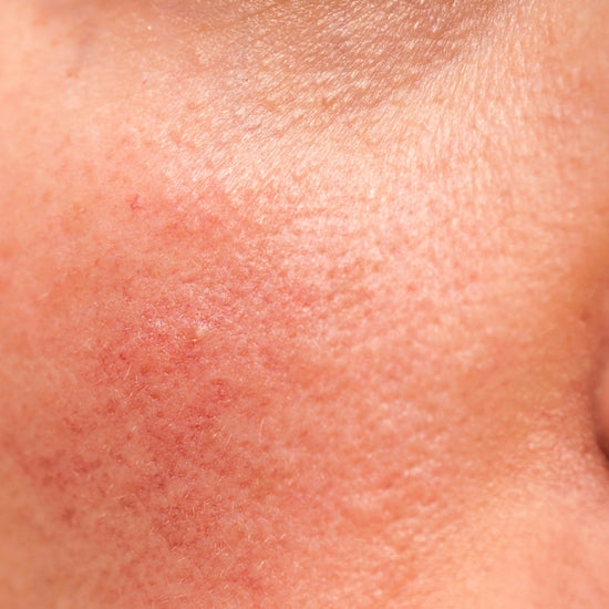 Close-up of reddish, irritated complexion.