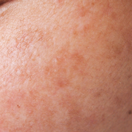 Close up of splotchy complexion.