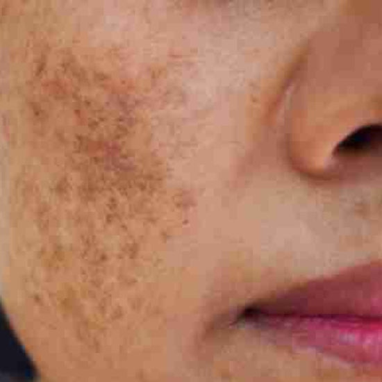 Close-up of dark spots on woman's face.