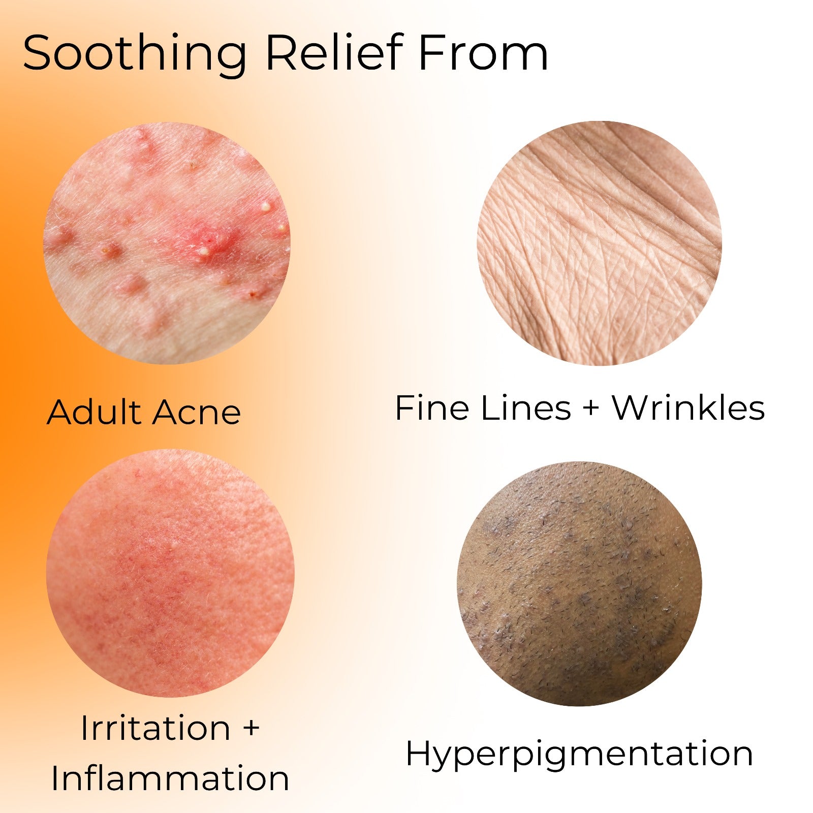 Soothing relief from adult acne, irritation and inflammation, fine lines and wrinkles, and hyperpigmentation.